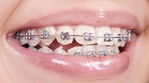 Silver Braces Silver Braces Braces Colors Dental Braces