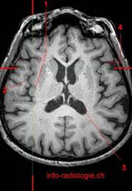 Horizontal Plane Insula With Images Audiology