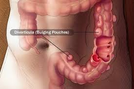 Image result for Diverticulitis
