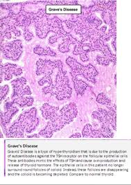 Most patients do have an associated autoimmune disorder such as systemic lupus erythematosus. Thyroid Gland Clinical Cases Flashcards Quizlet