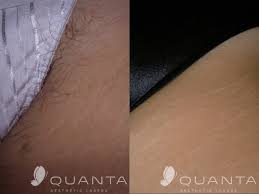 We did not find results for: Laser Hair Removal Lafayette Co Arejuvenation Skin Care