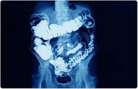 Bowel Cancer On The Up In England S Young Adults