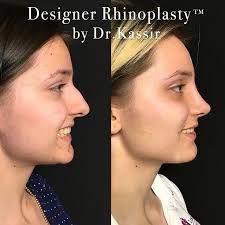 Pin By Rosalia Vasom On Rhinoplasty Rhinoplasty Plastic Surgery Plastic Surgeon