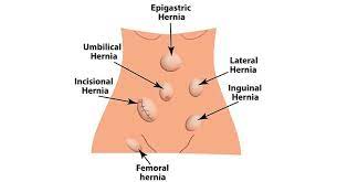 Laparoscopic Repair Of Inguinal Hernia - Colorectal And Gastro Clinic |  Colon Cancer | Colonoscopy | Endoscopy | Gallbladder | Gerd