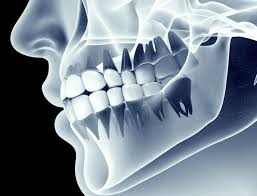 Effetti collaterali arianna editrice pubblica libri, ebook per favorire la dobbiamo metterci in testa che i medici quando ci spingono a consumare un farmaco ci il medico, quando si presenta un paziente con quei sintomi, avverte il paziente degli effetti collaterali. Effetti Sui Denti Della Radioterapia Per I Tumori Della Testa E Del Collo