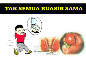 Penyebab terjadinya buasir hingga saat ini diyakini. Hidup Sihat Bebas Penyakit Agencia Consultora 46 Fotos Facebook