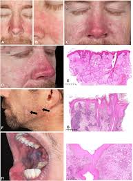 Skin Manifestations in Adults With Chronic Granulomatous Disease in the  United Kingdom