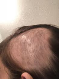 Talk to your doctor about cortisone shots or acupuncture for perimenopause hair loss. After Months Of Loss I M Finally Seeing Some Regrowth Steroid Shots Might Not Work For Everyone But They Worked For Me Alopecia Areata
