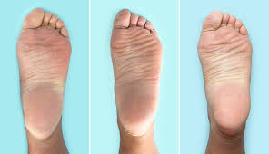 However, the calluses on your feet will make your feet blend the overripe banana to form a thick paste. Baby Foot Peel Reviews Dupes And What To Know Before You Try It Self