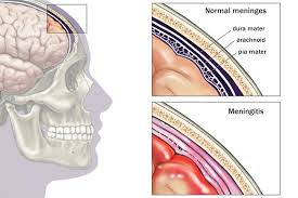 There might also be a rash that doesn't disappear if you press in younger children and babies, meningitis is very hard to diagnose on symptoms alone. Visual Guide To Meningitis