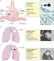 Aspergillosis — infection with the fungus aspergillus, seen especially in people with a deficient immune system. Different Stages Of Invasive Pulmonary Aspergillosis Ipa And The Download Scientific Diagram