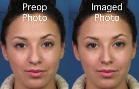 Contouring for a wide nose: Bulbous Wide Nasal Tip