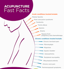 Maybe you would like to learn more about one of these? Acupuncture Faq Life Point Acupuncture