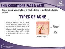 Pin On Acne