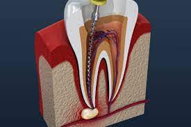 Then my 2nd molar on the top right hand side came. Think You May Need A Root Canal During Covid 19 Find Out What To Do