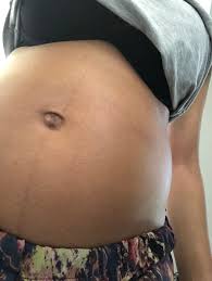 How to get rid of linea nigra post. Linea Nigra Anyone Belly Line April 2019 Babies Forums What To Expect