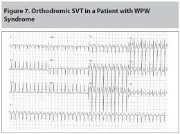 Supraventricular tachycardia (svt) is as an abnormally fast or erratic heartbeat that affects the heart's upper chambers. Supraventricular Tachycardia A Review For The Practicing Emergency Physician 2015 06 09 Ahc Media Continuing Medical Education Publishing