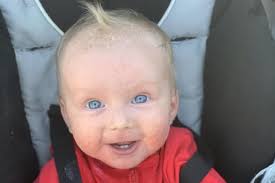 Apology for mother with ichthyosis who was kicked off a plane