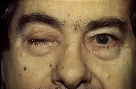 Image result for Pupillary Paralysis