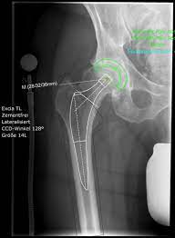 Huftgelenksarthrose Vulpius Klinik