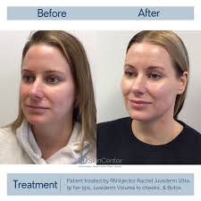 Full face rejuvenation using Juvederm Hyaluronic Acid Fillers. RN Injector  Rachel used Juvederm Voluma in the cheeks, Juvederm Ulta in the lips, and  Botox to the upper face to create this naturally
