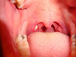 We did not find results for: Pictures Of White Bumps In The Throat Youmemindbody