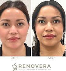 Look at this amazing transformation!🙌🏼🙌🏼 These incredible results are  from just 6 sessions of BBL laser treatments for acne. You can really see  the difference! 😍 BBL Laser Treatments Benefits:‼️‼️ • Reduces