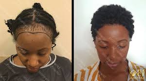 Wordt u haar dunner of. Hairworld Istanbul Kroeshaar Behandeling Fue Ct Haartransplantatie Van Simone Bij Hairworldistanbul Facebook