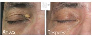 Image result for xantelasma