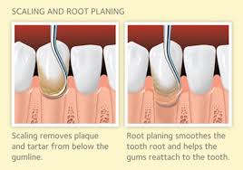 Deep Cleaning Your Teeth: All You Need to Know About Scaling and Root Planing