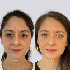 Hey does anyone need lip filler models London and possibly something to fix  skin brighten/boosters and anyone doing vitamin shots etc thanks 💚💚  central London preferably Bromley etc if possible