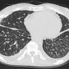 As the primary tumor increases in size and spreads to neighboring tissues and lymph nodes, cancerous masses begin to block airways and make breathing painful. 1