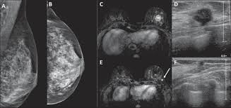 When cancer is suspected, imaging techniques reveal accurate details of tumours, increasing the chances of successful treatment; Scielo Brasil Role Of Magnetic Resonance Imaging In The Planning Of Breast Cancer Treatment Strategies Comparison With Conventional Imaging Techniques Role Of Magnetic Resonance Imaging In The Planning Of Breast
