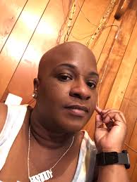 Alopecia universalis condition causes complete hair loss