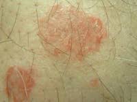 Image result for Eczema nummulare