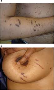Image result for koebner phenomenon psoriasis