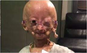 Adalia Rose Wiki Bio Age Dating Family Youtube Videos And Progeria