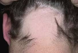 Most white people will start to see white hairs by the age of 35, asians by the age of 40 and. Alopecia Areata Signs Treatment Symptoms Causes In Children