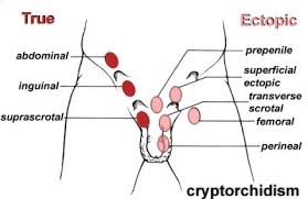 A condition in which one or both testes fail to descend normally. Urology Cryptorchidism Testicular Torsion Hydrocele Varicocele Flashcards Quizlet
