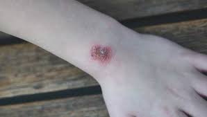 Before your appointment, you might want to write a list that includes: How To Get Rid Of Mrsa Treatments