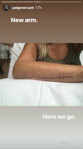 Paige vanzant, who fought two rounds with a broken arm at ufc st. Paige Vanzant Reveals Her New Arm After Back To Back Surgeries Mma