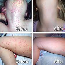 The alcohol can soak into the lesions and neutralize the virus. Zymaderm Molluscum Warts Skin Care Natural Gentle Painless 13 Ml Amazon Co Uk Health Personal Care