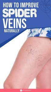 How To Improve Spider Veins Naturally In 2020 Spider Veins Spider Vein Remedies Get Rid Of Spider Veins
