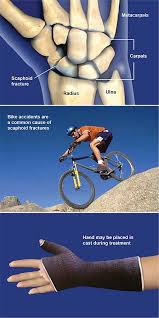 Image result for Scaphoid Bone