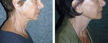 It also becomes easier for the muscles to hold up the weight of the outer layers of skin. Non Surgical Facelift Non Surgical Face Lift Nyc