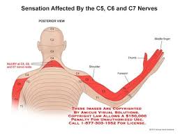 13128 04x Sensation Affected By The C5 C6 And C7 Nerves Anatomy Exhibits Cervical Spine Exercises Nerve Anatomy Cervical Spinal Stenosis