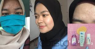 Dermatitis atau eksim mengacu pada sekelompok kondisi peradangan kulit. Setelah Puas Cuba Akhirnya Doktor Gigi Ini Rawat Kulit Breakout Dengan Hanya Produk Bajet Dari Drugstore Hijabista