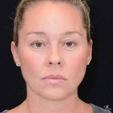 Face Procedures Chesterfield