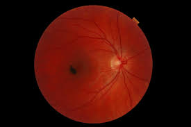 Maybe you would like to learn more about one of these? Medical Eye Conditions Strongsville Oh Greater Cleveland Eye Associates