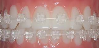 Pin By Norris Orthodontics On Types Of Clear Braces Clear Braces Ceramic Braces Braces Colors